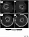 Fig. 22 - Assessment of arterial calcifications