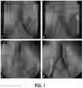 Fig. 02 - ENDOVASCULAR OCCLUSION DEVICE AND METHOD OF USE