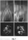 Fig. 10 - ENDOVASCULAR OCCLUSION DEVICE AND METHOD OF USE