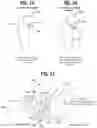 Fig. 09 - Radial saw blade and hub for osteotomy