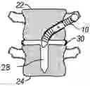 Fig. 01 - Distraction screw