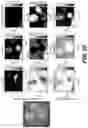 Fig. 22 - System, method and computer-accessible medium for catheter-based optical determination of met-myoglobin content for estimating radiofrequency ablated, chronic lesion formation in tissue