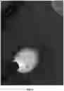 Fig. 04 - HEMOSTATIC PASTE WITH LIGHT-CURABLE FEATURE
