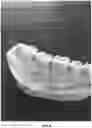Fig. 06 - HEMOSTATIC PASTE WITH LIGHT-CURABLE FEATURE