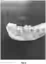 Fig. 07 - HEMOSTATIC PASTE WITH LIGHT-CURABLE FEATURE