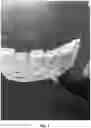 Fig. 08 - HEMOSTATIC PASTE WITH LIGHT-CURABLE FEATURE