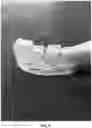 Fig. 09 - HEMOSTATIC PASTE WITH LIGHT-CURABLE FEATURE