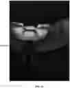 Fig. 16 - HEMOSTATIC PASTE WITH LIGHT-CURABLE FEATURE
