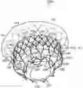 Fig. 01 - Prosthetic heart valve device and associated systems and methods