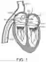 Fig. 02 - Prosthetic heart valve device and associated systems and methods