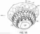 Fig. 08 - Prosthetic heart valve device and associated systems and methods