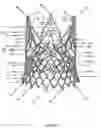 Fig. 45 - Stent for the positioning and anchoring of a valvular prosthesis in an implantation site in the heart of a patient