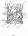 Fig. 46 - Stent for the positioning and anchoring of a valvular prosthesis in an implantation site in the heart of a patient