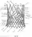 Fig. 47 - Stent for the positioning and anchoring of a valvular prosthesis in an implantation site in the heart of a patient