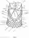 Fig. 49 - Stent for the positioning and anchoring of a valvular prosthesis in an implantation site in the heart of a patient