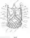 Fig. 50 - Stent for the positioning and anchoring of a valvular prosthesis in an implantation site in the heart of a patient