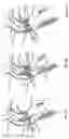 Fig. 56 - Stent for the positioning and anchoring of a valvular prosthesis in an implantation site in the heart of a patient