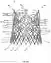 Fig. 59 - Stent for the positioning and anchoring of a valvular prosthesis in an implantation site in the heart of a patient