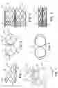 Fig. 02 - Stented heart valve devices and methods for atrioventricular valve replacement