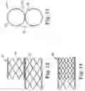 Fig. 04 - Stented heart valve devices and methods for atrioventricular valve replacement