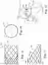 Fig. 05 - Stented heart valve devices and methods for atrioventricular valve replacement