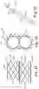 Fig. 06 - Stented heart valve devices and methods for atrioventricular valve replacement
