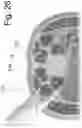 Fig. 28 - Spinal fixation devices and methods of use