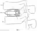 Fig. 02 - Expandable fusion device and method of installation thereof