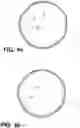 Fig. 07 - INFLATABLE LIMB PROSTHESIS