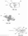 Fig. 10 - Methods and devices for treating sleep apnea