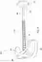 Fig. 15 - Methods and devices for treating sleep apnea