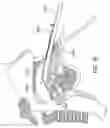Fig. 24 - Methods and devices for treating sleep apnea