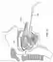 Fig. 25 - Methods and devices for treating sleep apnea