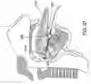 Fig. 28 - Methods and devices for treating sleep apnea