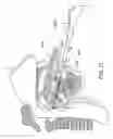 Fig. 29 - Methods and devices for treating sleep apnea