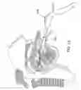 Fig. 31 - Methods and devices for treating sleep apnea