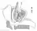 Fig. 32 - Methods and devices for treating sleep apnea