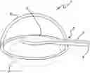 Fig. 01 - Capsulotomy device
