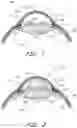 Fig. 02 - MINIMALLY INVASIVE GLAUCOMA SURGICAL INSTRUMENT AND METHOD