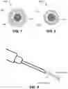 Fig. 07 - EXCIMER LASER FIBER ILLUMINATION