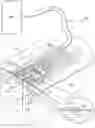Fig. 01 - DRESSING WITH CONTRACTING LAYER FOR LINEAR TISSUE SITES