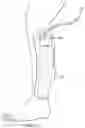 Fig. 11 - Area management of tissue sites on articulating joints
