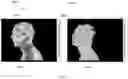 Fig. 09 - Method for administering solid water particles to prevent bacteria growth in living organisms