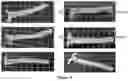 Fig. 05 - METHOD AND COMPOSITION FOR REVERSING AND/OR INHIBITING ATHEROSCLEROSIS