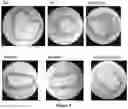Fig. 06 - METHOD AND COMPOSITION FOR REVERSING AND/OR INHIBITING ATHEROSCLEROSIS