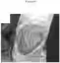 Fig. 22 - C. novyi for the treatment of solid tumors in humans