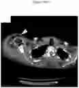 Fig. 33 - C. novyi for the treatment of solid tumors in humans