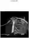 Fig. 43 - C. novyi for the treatment of solid tumors in humans