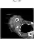 Fig. 45 - C. novyi for the treatment of solid tumors in humans