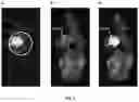 Fig. 06 - Preparation for magnetic resonance diagnostics for oncological diseases, comprising deuterated 3-O-methylglucose, and diagnostic method using said preparation